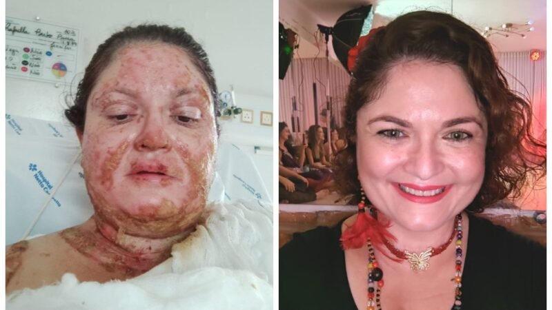 Com dança, professora supera acidente que queimou 40% do corpo: ‘me  trouxe de volta à vida’