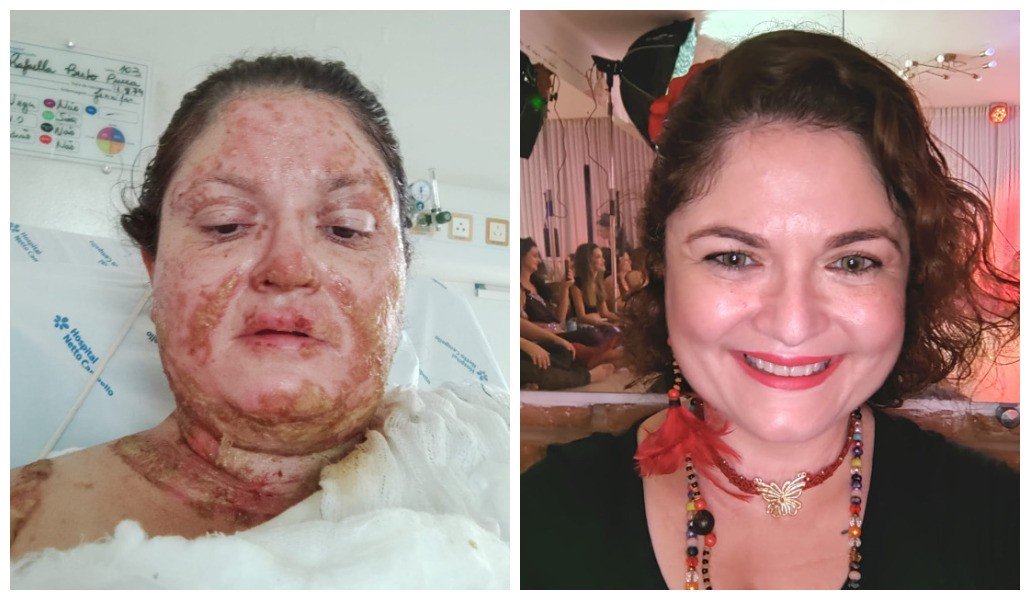 Com dança, professora supera acidente que queimou 40% do corpo: ‘me trouxe de volta à vida’ Com dança, professora supera acidente que queimou 40% do corpo: ‘me trouxe de volta à vida’