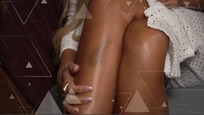 Lipedema: Yasmin Brunet fala sobre a doença em entrevista ao Fantástico Lipedema: Yasmin Brunet fala sobre a doença em entrevista ao Fantástico