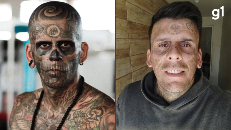Lembra dele? ‘Mais tatuado do Brasil’ passa por 4ª sessão de remoção de tatuagens no rosto e compartilha resultados