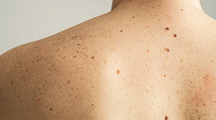 Cuide da sua pele:prevenção e diagnóstico precoce do câncer de pele não melanoma