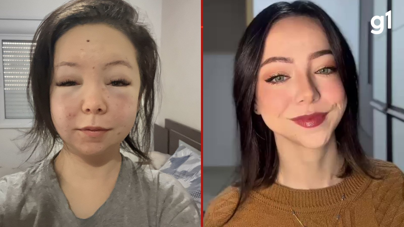 Quatro anos até dar nome à dor: por que tumor em jovem do RS levou tanto tempo para ser diagnosticado Quatro anos até dar nome à dor: por que tumor em jovem do RS levou tanto tempo para ser diagnosticado