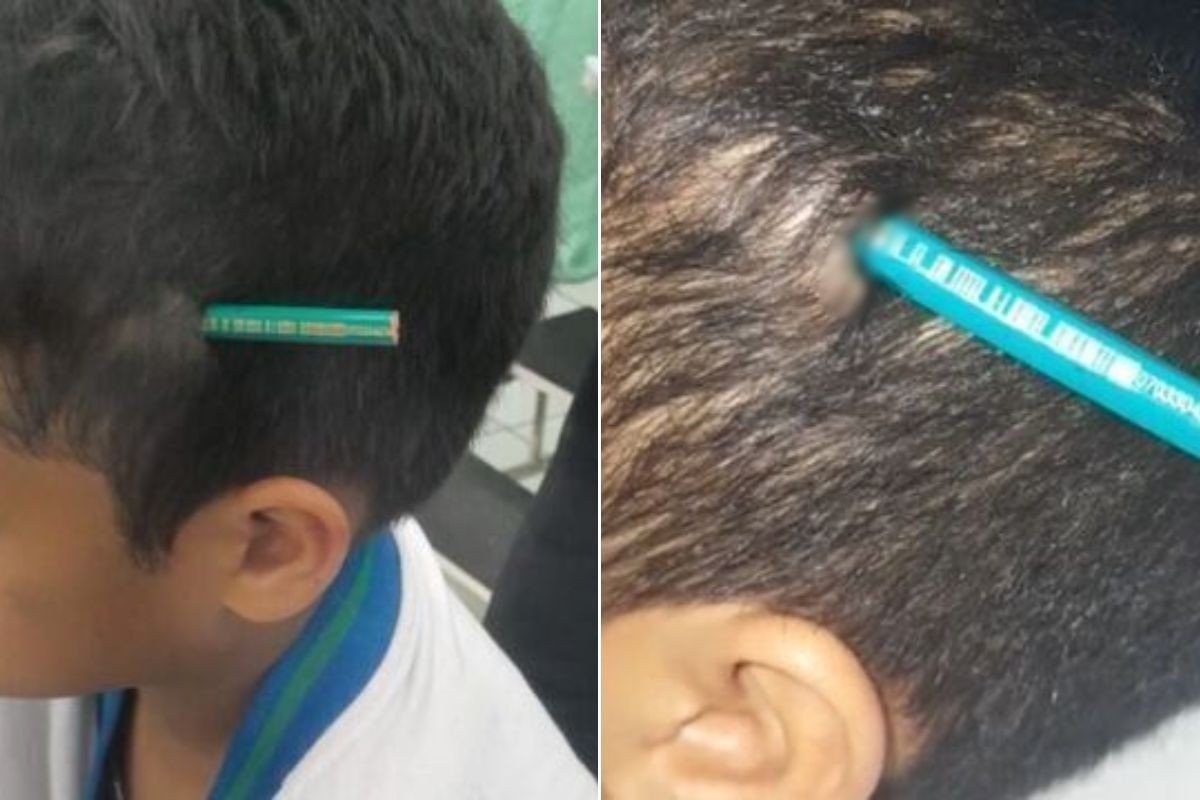 Veja o que aconteceu com o aluno que cravou lápis na cabeça de colega dentro de escola no litoral de SP