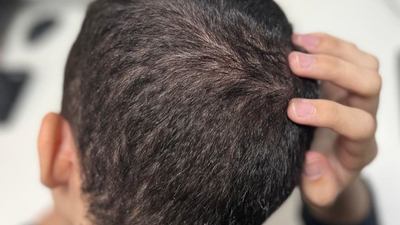 Volta às aulas aumenta casos de piolhos em crianças; veja como identificar e tratar