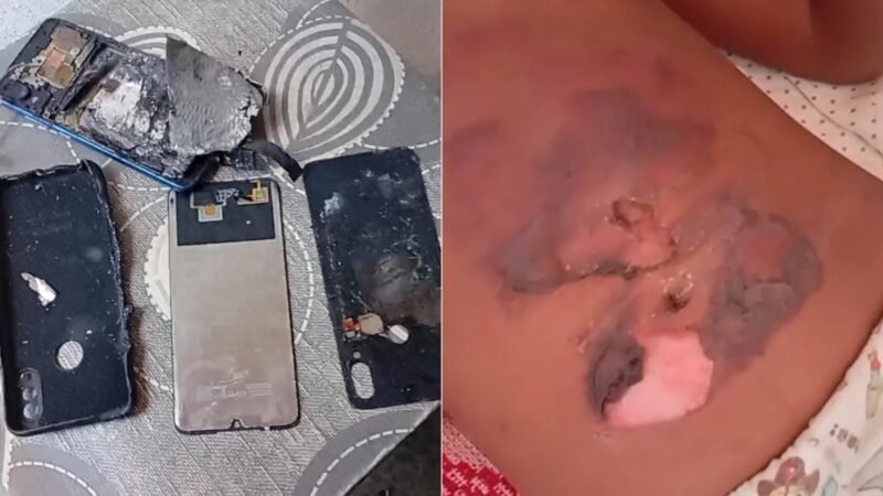 Celular pega fogo e criança de 10 anos sofre queimaduras no interior do RN