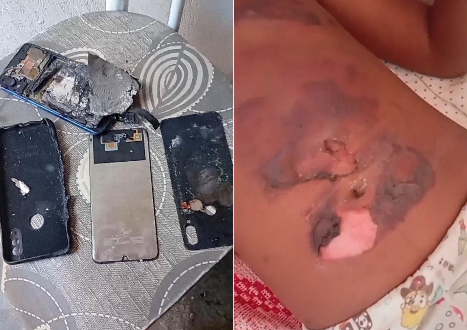 Celular pega fogo e criança de 10 anos sofre queimaduras no interior do RN