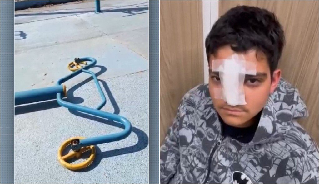 Adolescente fratura ossos do rosto após ser atingido por aparelho de academia ao ar livre em Campinas Adolescente fratura ossos do rosto após ser atingido por aparelho de academia ao ar livre em Campinas