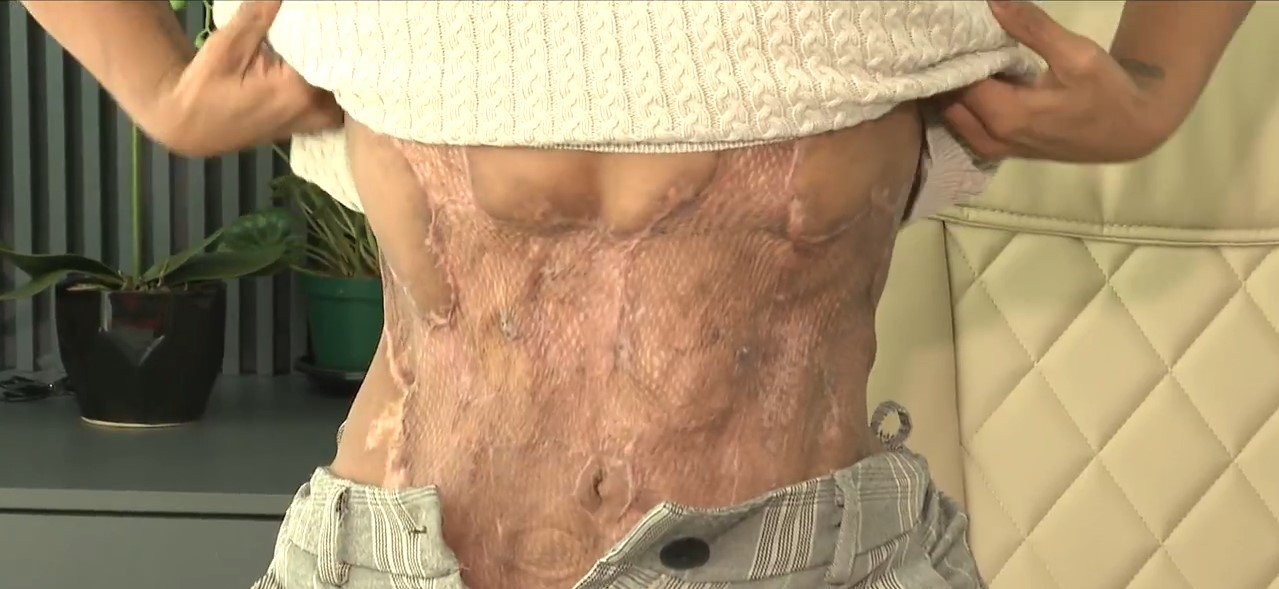 ‘X-Tudo’: médico condenado por causar lesões e necrose em paciente de SC segue proibido de exercer medicina