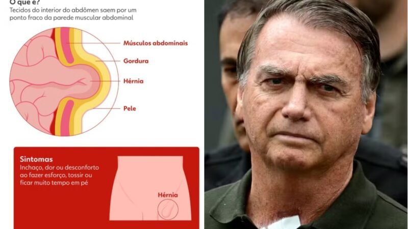 Termina cirurgia de Bolsonaro para tratamento de hérnia em hospital de Brasília