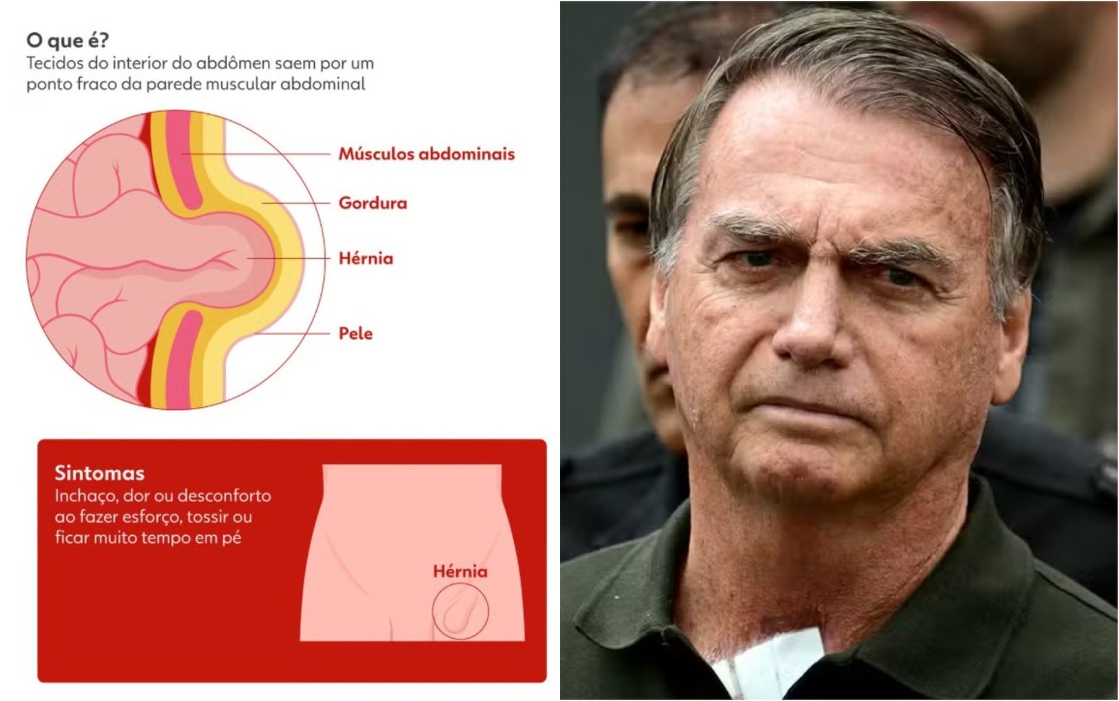 Termina cirurgia de Bolsonaro para tratamento de hérnia em hospital de Brasília