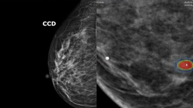 IA prevê risco de câncer de mama com 5 anos de antecedência