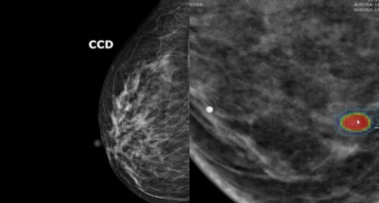 IA prevê risco de câncer de mama com 5 anos de antecedência