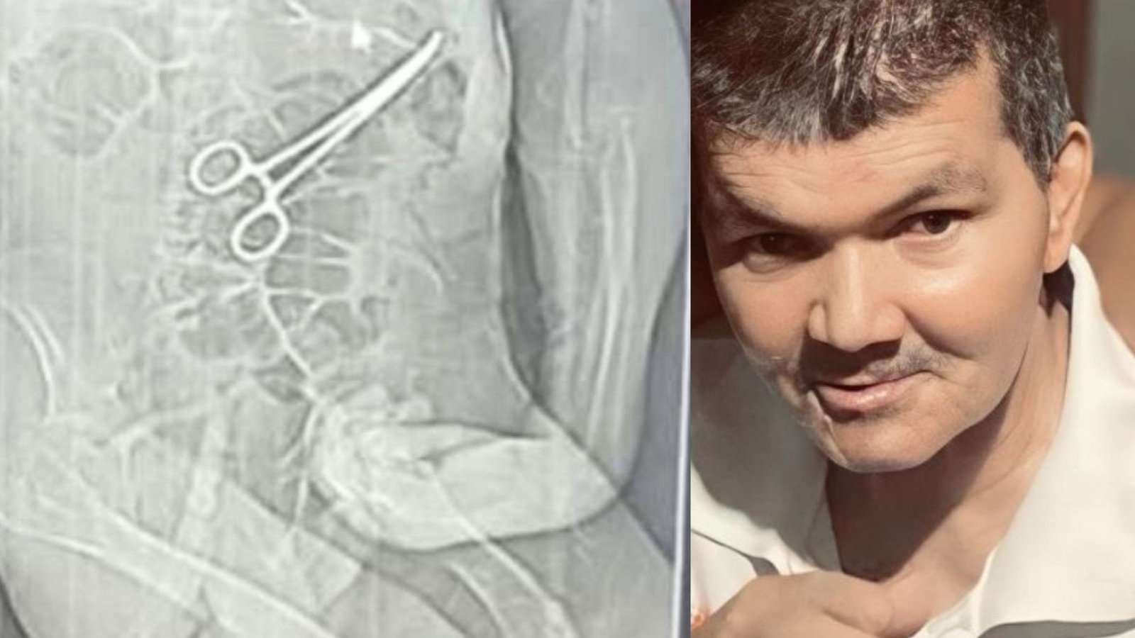 Família de paciente que ficou com pinça dentro do corpo afirma que hospital omitiu erro e fez cirurgia para retirada sem avisar