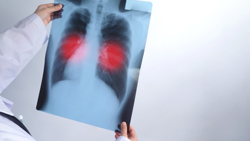 Paraíba registra mais de 1.580 casos de tuberculose em 2025